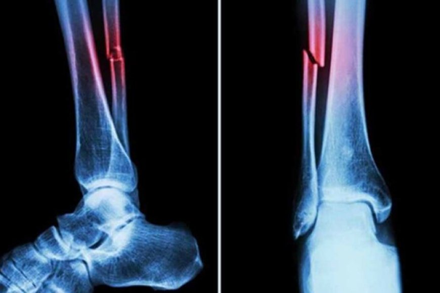 nit-की-रिसर्च:-हड्डियों-की-मरम्मत-के-लिए-प्रोटीन-से-नए-उपचार-के-रास्ते