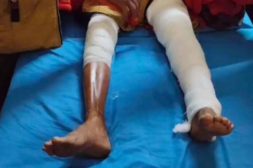 ऑपरेशन-में-लापरवाही!-इलाज-के-बाद-छोटा-हो-गया-मरीज-का-पैर,-आयोग-ने-दिया-3-लाख-का-मुआवजा